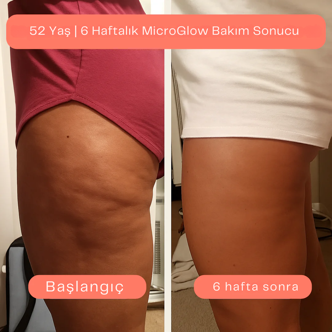 MicroGlow™  Anti Selülit Yağ Seti 80 ML